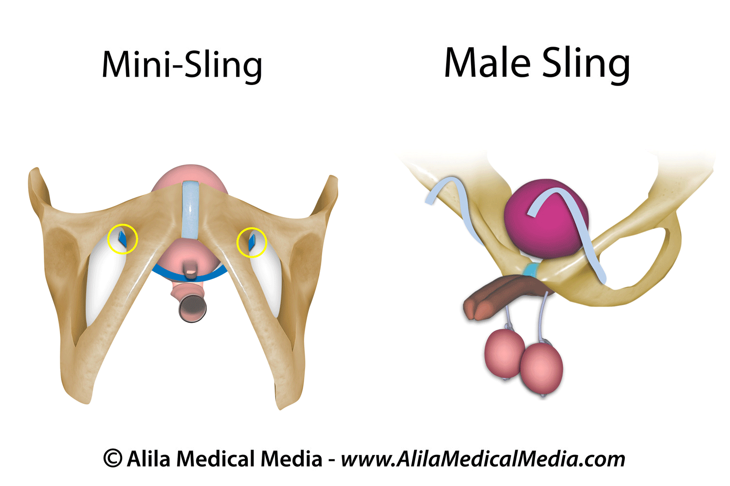 Mini sling and mail sling to treat bladder incontinence.