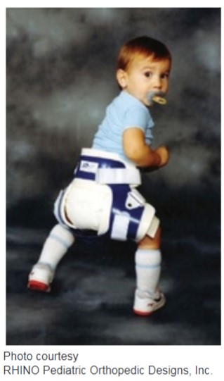 A child wears a hip abduction orthosis.