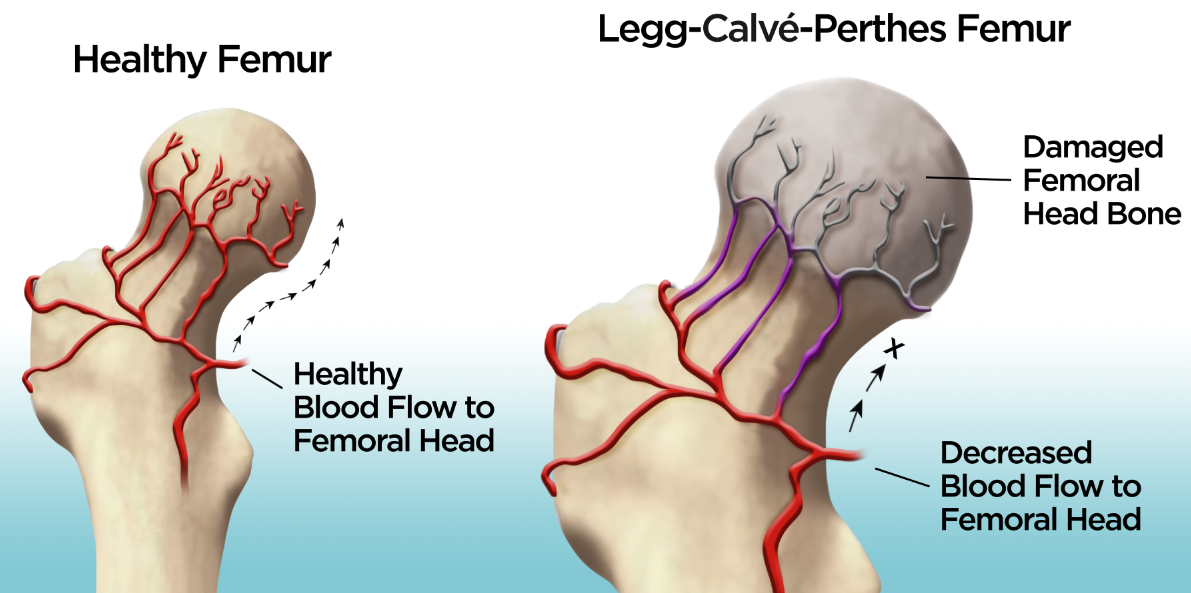 Image of the difference between a healthy Femur and the condition  Legg calve Perthes