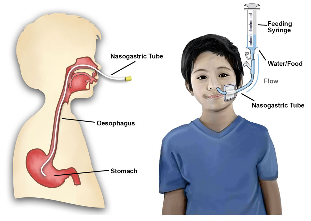 nasogastric tube illustration of how food/water travels to stomach