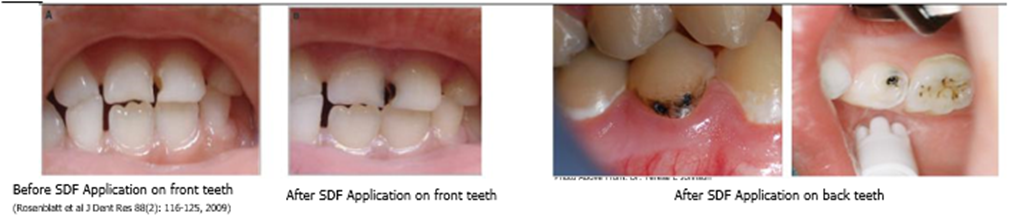An example of teeth after using SDF application.