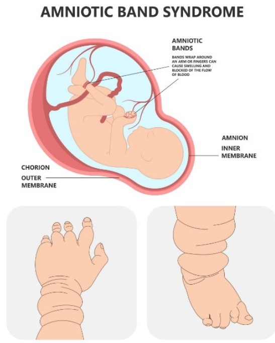 Amniotic band syndrome diagram. 