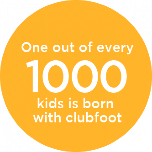 Clubfoot | Gillette Children's Specialty Healthcare