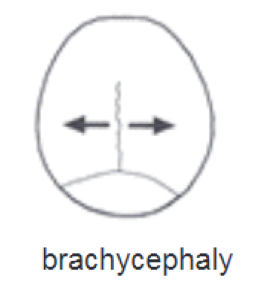 Drawing showing brachycephaly, a shape associated with bilateral coronal synostosis (along with turricephaly, not pictured)