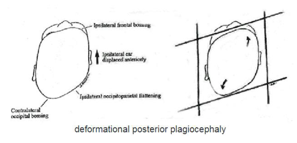 drawing showing deformational posterior plagiocephaly