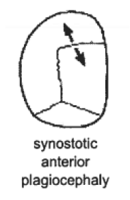 Drawing showing synostotic anterior plagiocephaly associated with coronal synostosis
