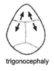 drawing representing the head shape, trigonocephaly