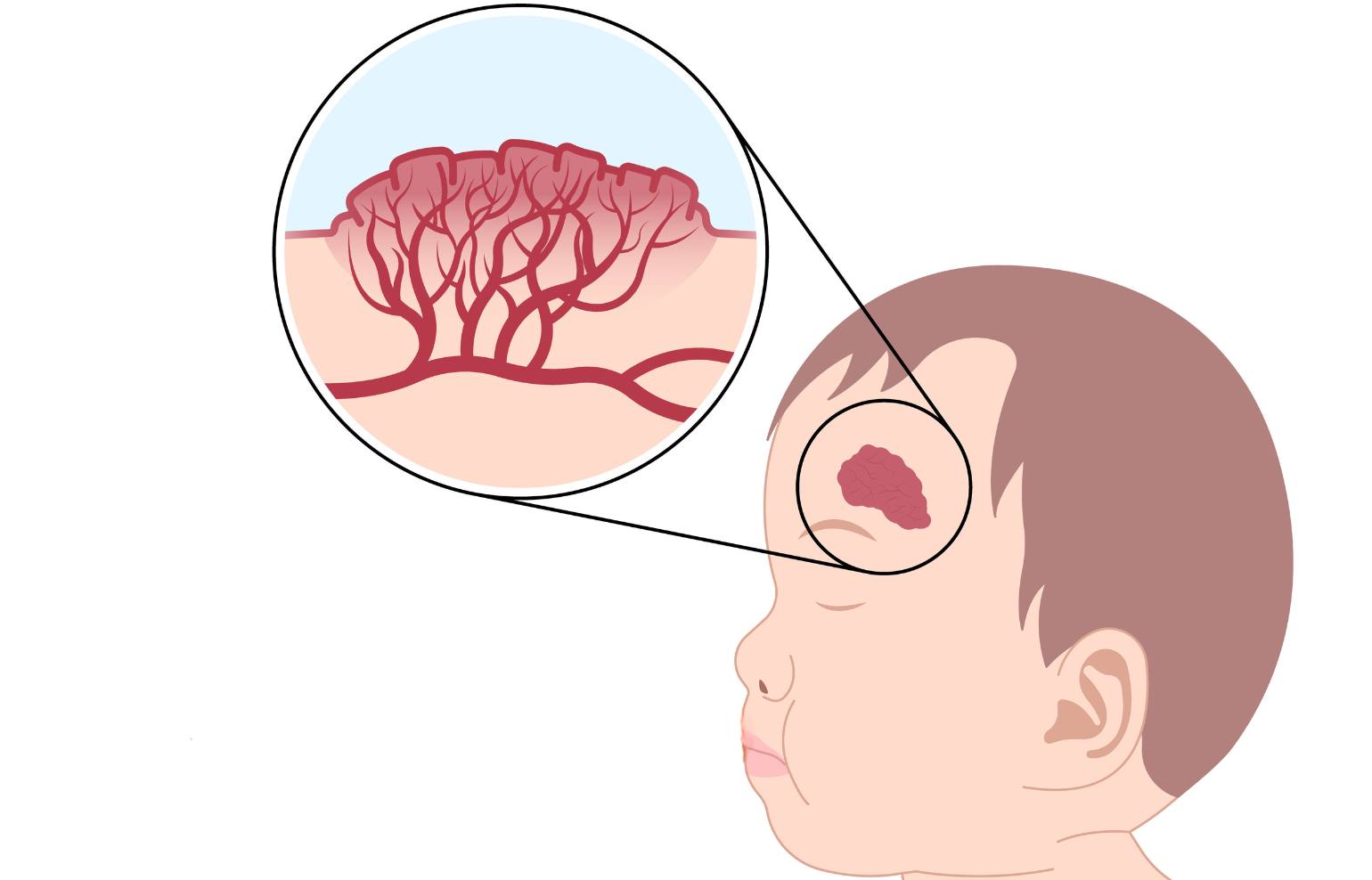 An illustration showing the left side of an infant's face with a hemangioma above the left eyebrow, with a detail of what a hemangioma looks like under the surface of the skin.
