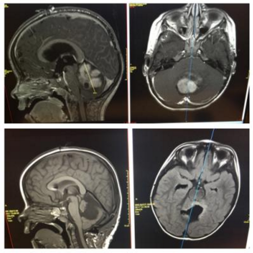 Before and after scans of Emmy's brain