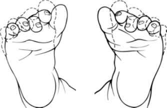 graphic of the toes in a curved foot posture - Gillette Children's