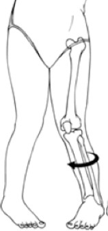 graphic of the twisted shinbone position - Gillette Children's
