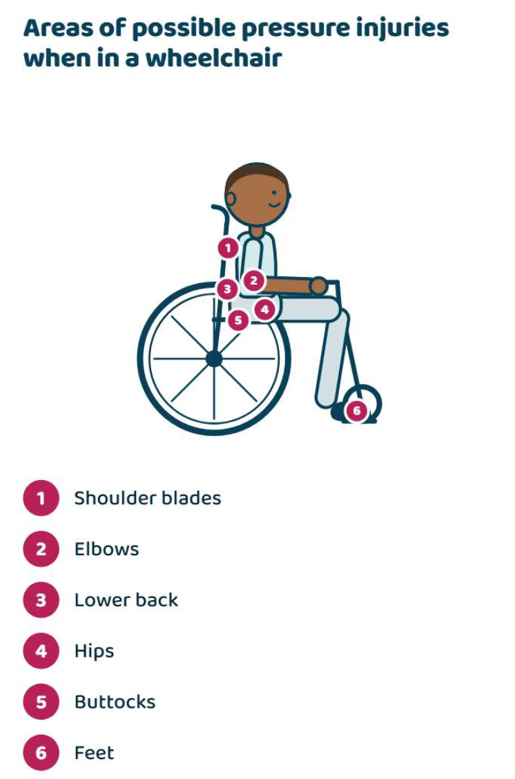 Areas of possible pressure injuries when in a wheelchair - Gillette Children's