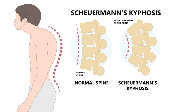 A digital illustration of Scheuermann's kyphosis of the spine as shown from the side, as well as what a typical spine looks like. Gillette Children's.