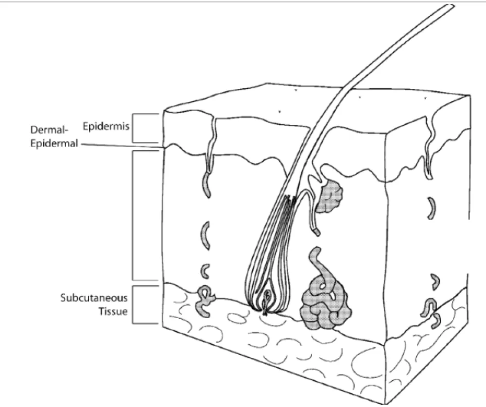 Congenital Nevus illustration