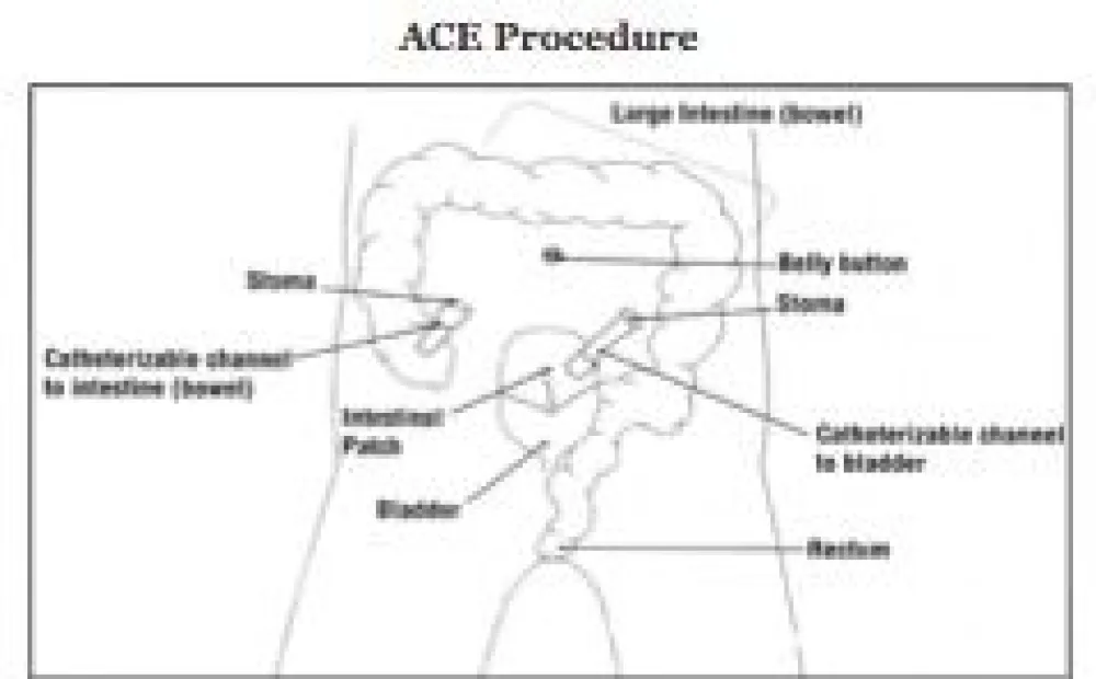 ACE procedure illustration  - Gillette Children's.