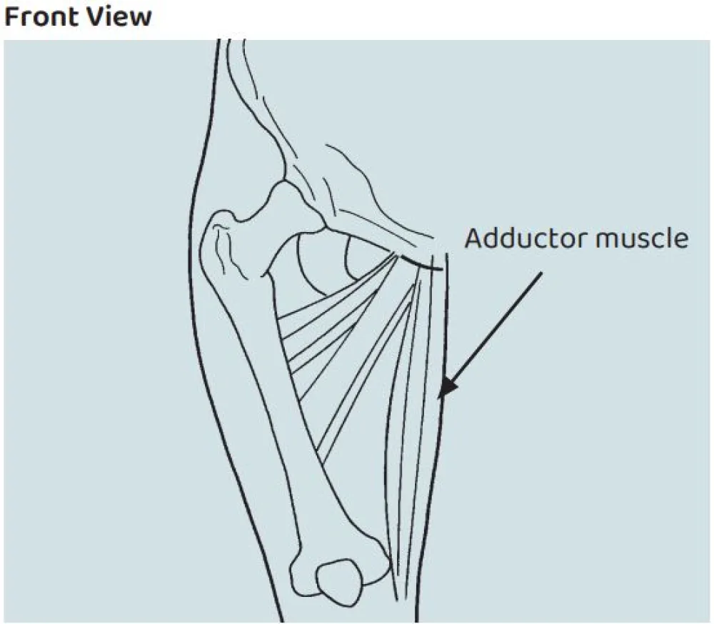 An illustration of the Adductor Lengthening procedure at Gillette Children's