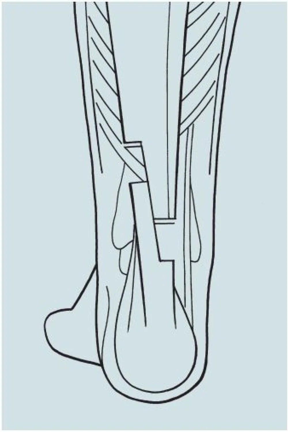 An lllustration of the Achilles Tendon Z-Lengthening or Percutaneous Tendon Lengthening procedure at Gillette Children's