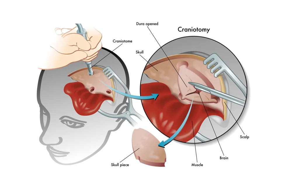 Illustration of a craniotomy for Gillette Children's