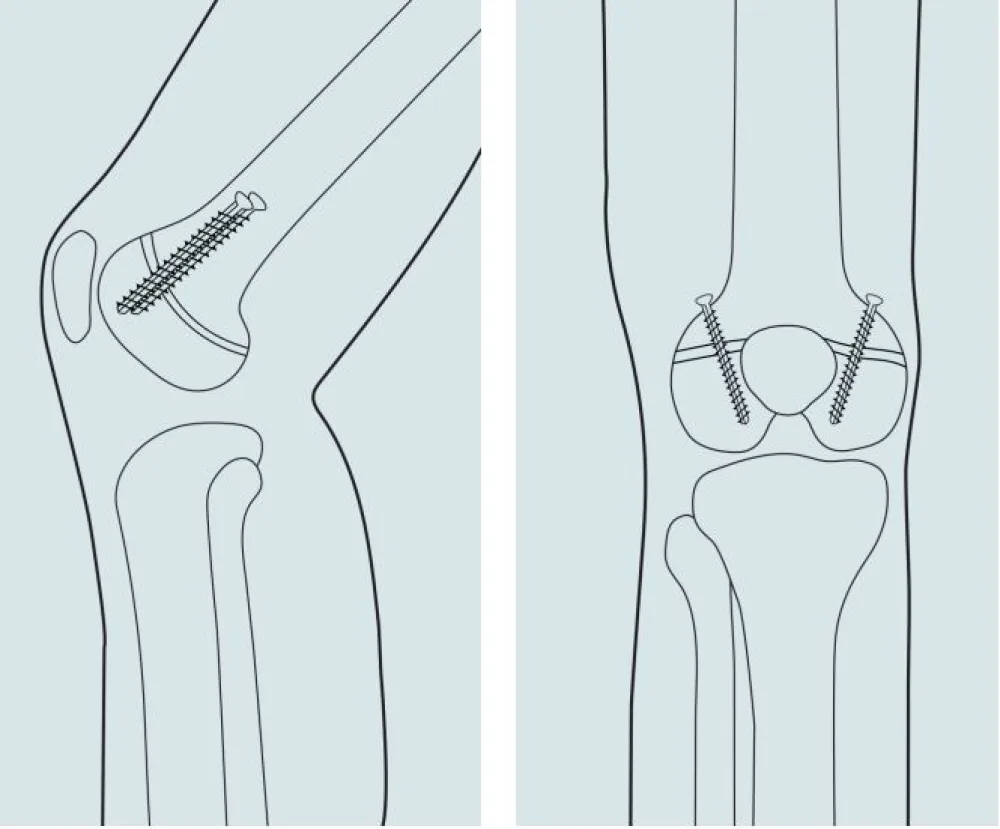 Anterior Distal Femur Guided Growth illustration - Gillette Children's.