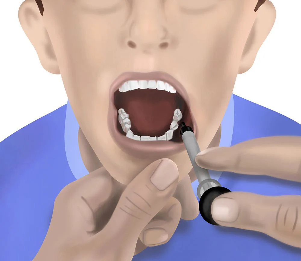 Shows an illustration of where the buccal space is in between the inside of the cheek and the teeth where some medication is administered.