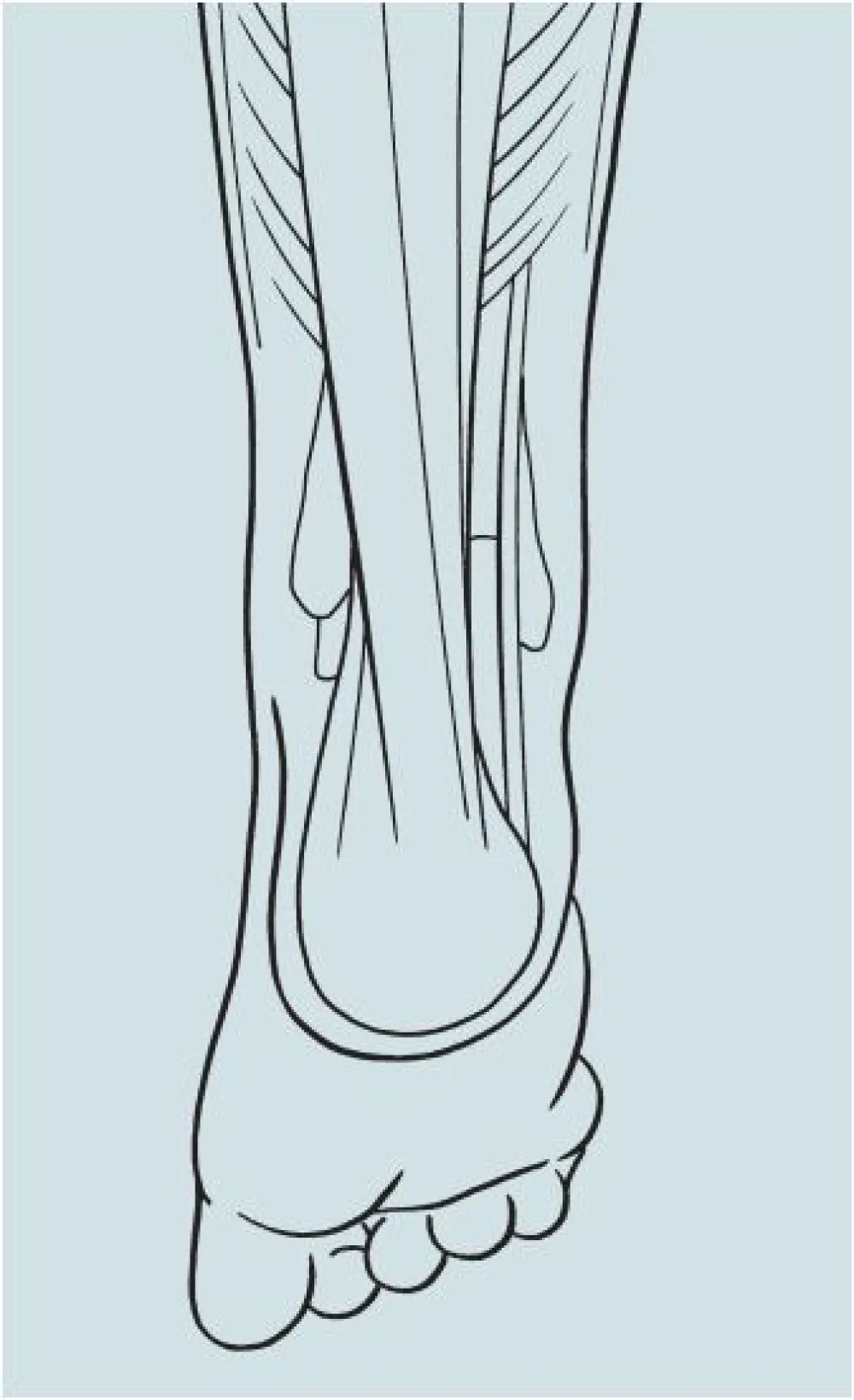 An illustration of the Calf Muscle (Gastrocnemius) Lengthening or Recession procedure at Gillette Children's