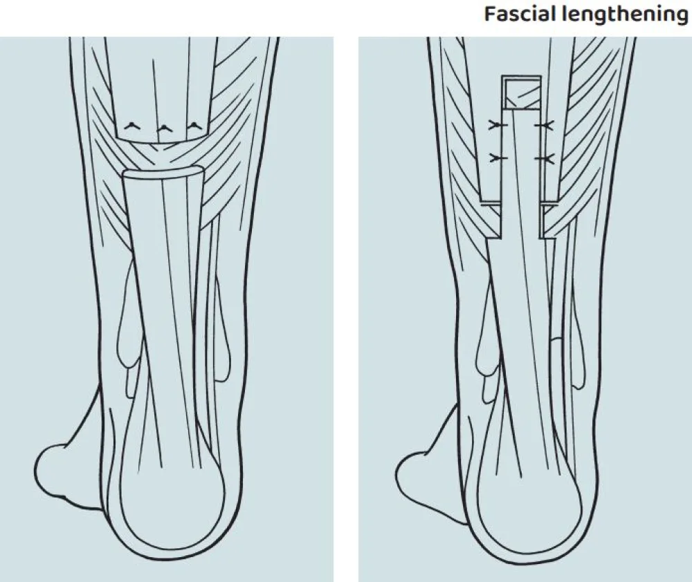 An illustration of the Calf Muscle (Gastrocnemius) Lengthening or Recession procedure at Gillette Children's