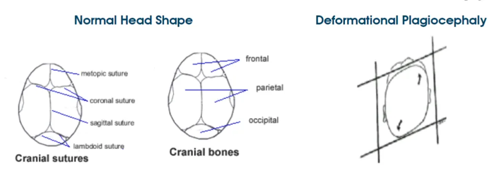 Deformational Plagiocephaly illustration.