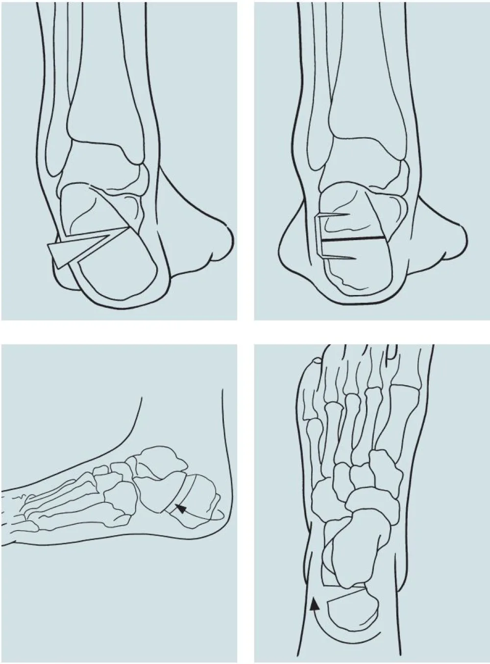 An illustration of the Calcaneal Osteotomy procedure at Gillette Children's