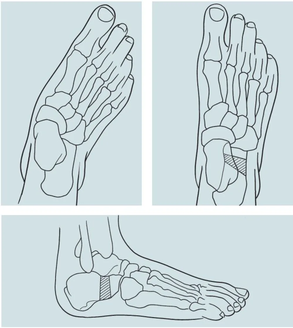 An illustration of a Calcaneal Lengthening procedure at Gillette Children's