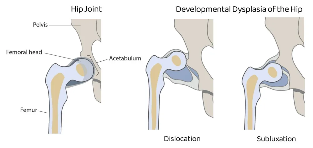 A illustration showing Developmental Dysplasia of the Hip (DDH) at Gillette Children's