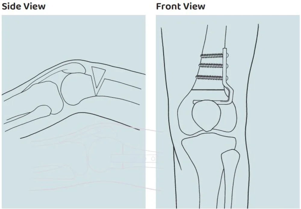 Illustration of Distal Femoral Extension Osteotomy procedure at Gillette Children's