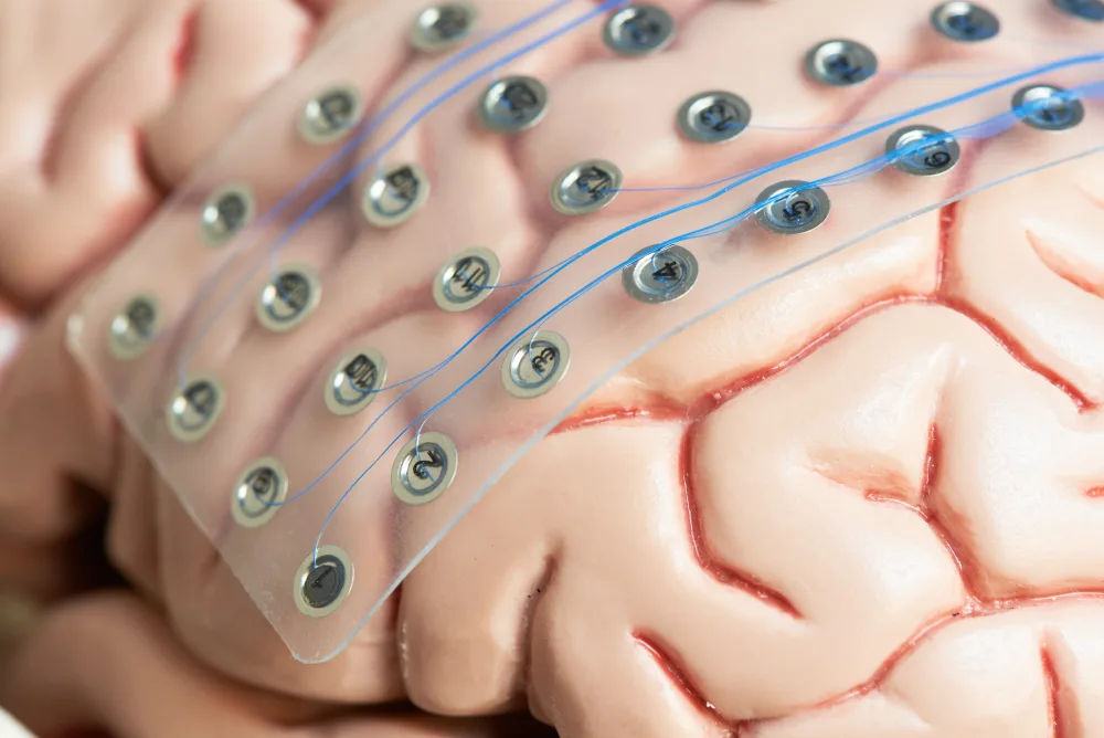 Illustration of invasive EEG.