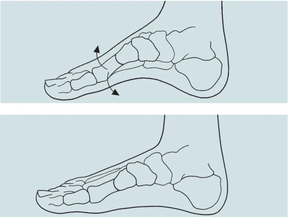 An illustration of a First Metatarsal Osteotomy procedure at Gillette Children's