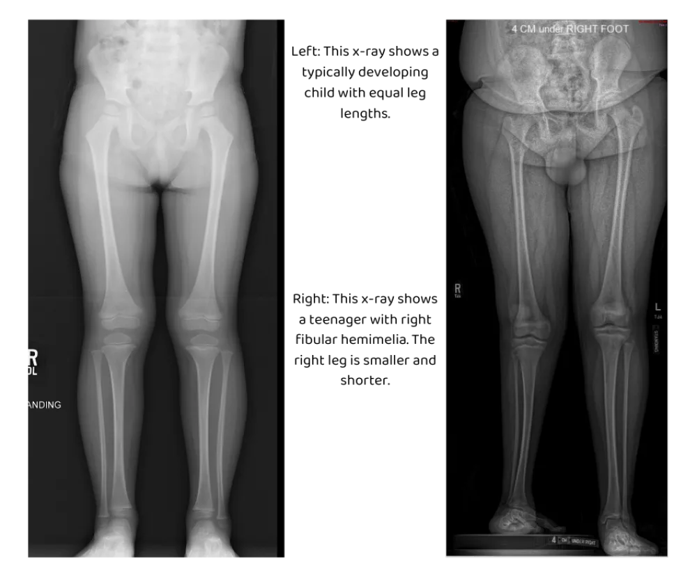 Illustrates a fibular hemimelia patient seen at Gillette Children's
