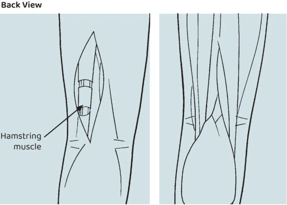 An illustration of the Hamstring Lengthening procedure at Gillette Children's