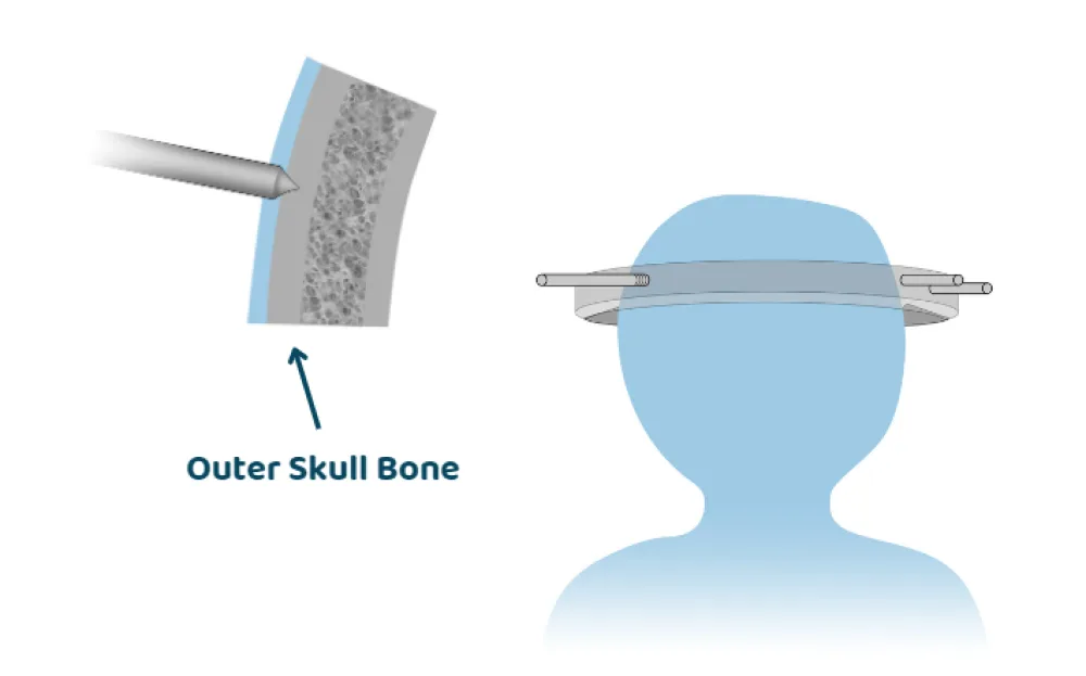 Illustration of how halo traction is attached.