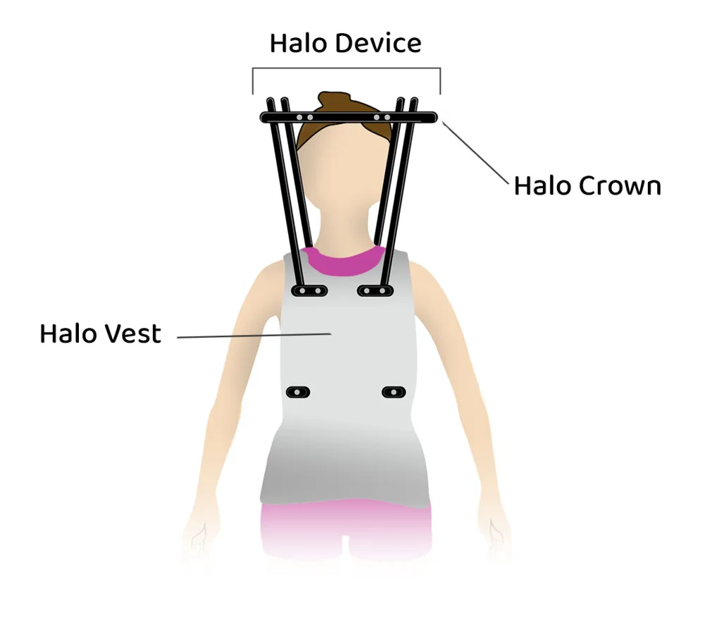 Halo vest illustration.