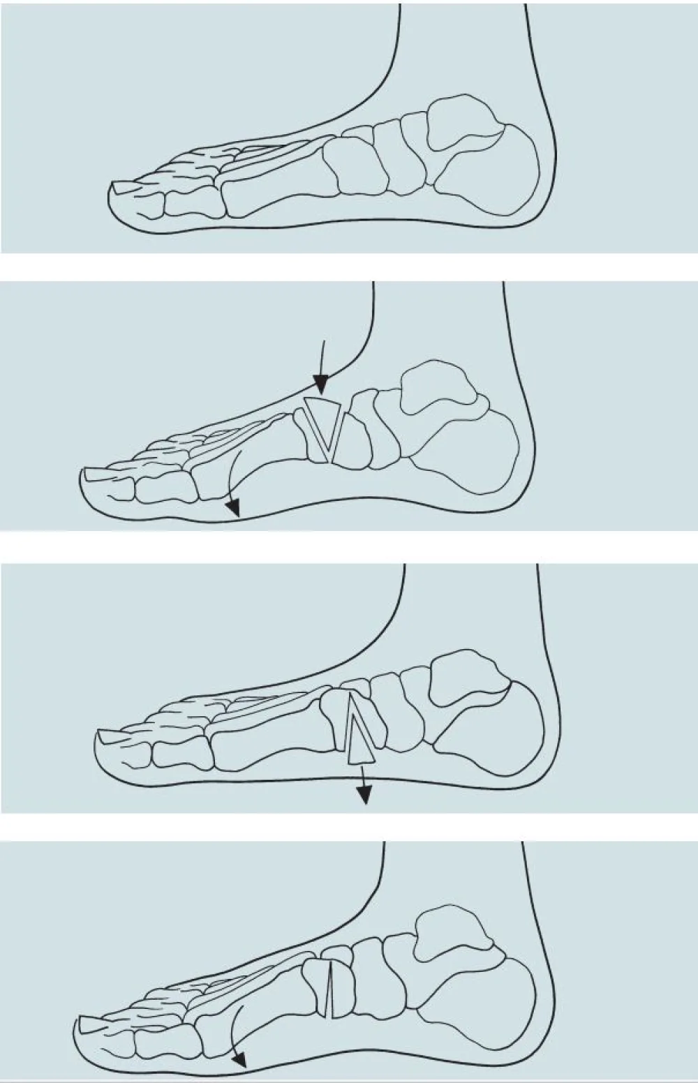 An illustration of Medial Cuneiform Osteotomy procedure at Gillette Children's