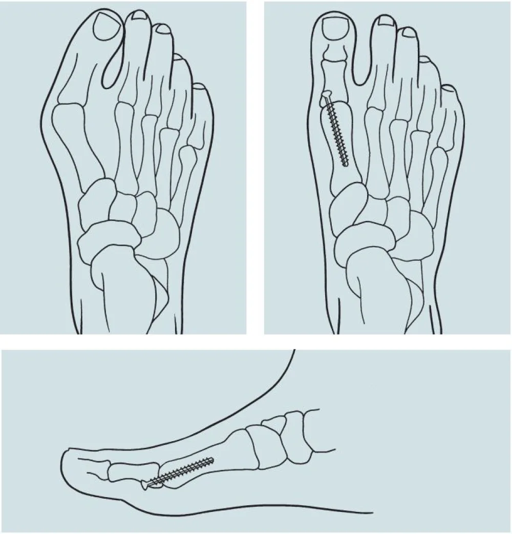 An illustration on the First Metatarsophalangeal (MTP) Joint Fusion procedure at Gillette Children's
