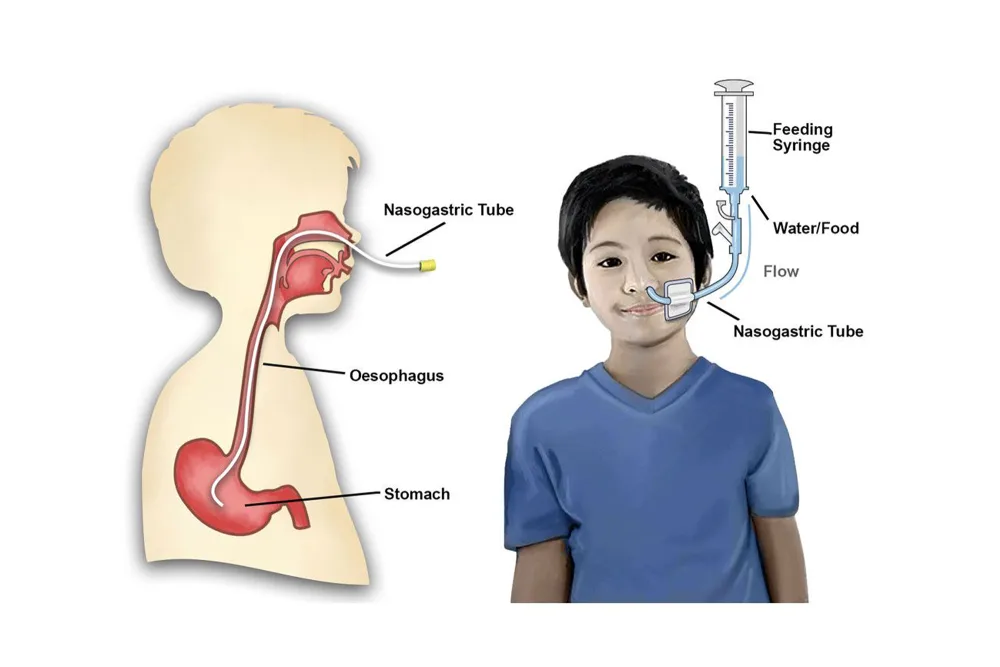 Nasogastric tube Illustration for Gillette Children's