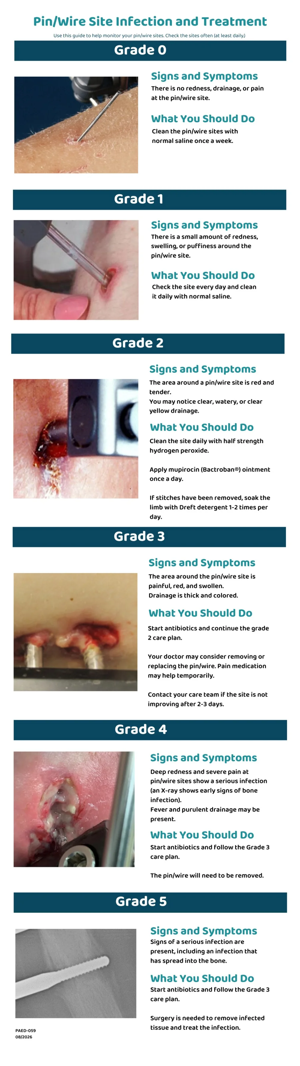 Graphic of Pin/Wire Site Infection and Treatment - Gillette Children's