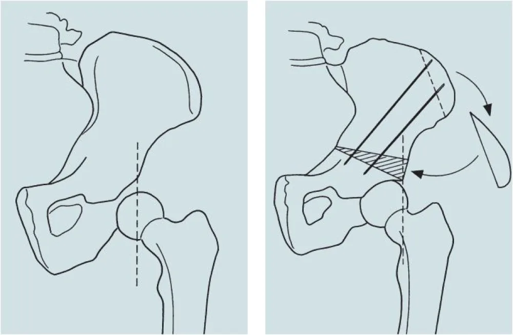 Illustration of Pelvic Osteotomy at Gillette Children's
