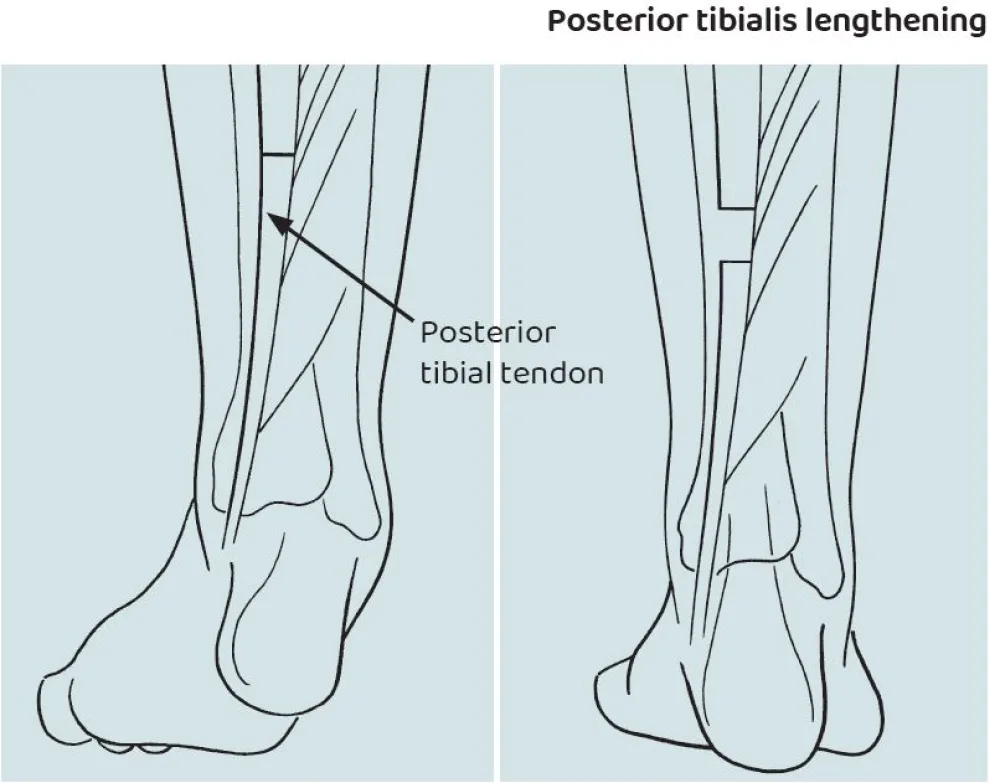 An illustration of the Posterior Tibialis Lengthening or Split Transfer procedure at Gillette Children's