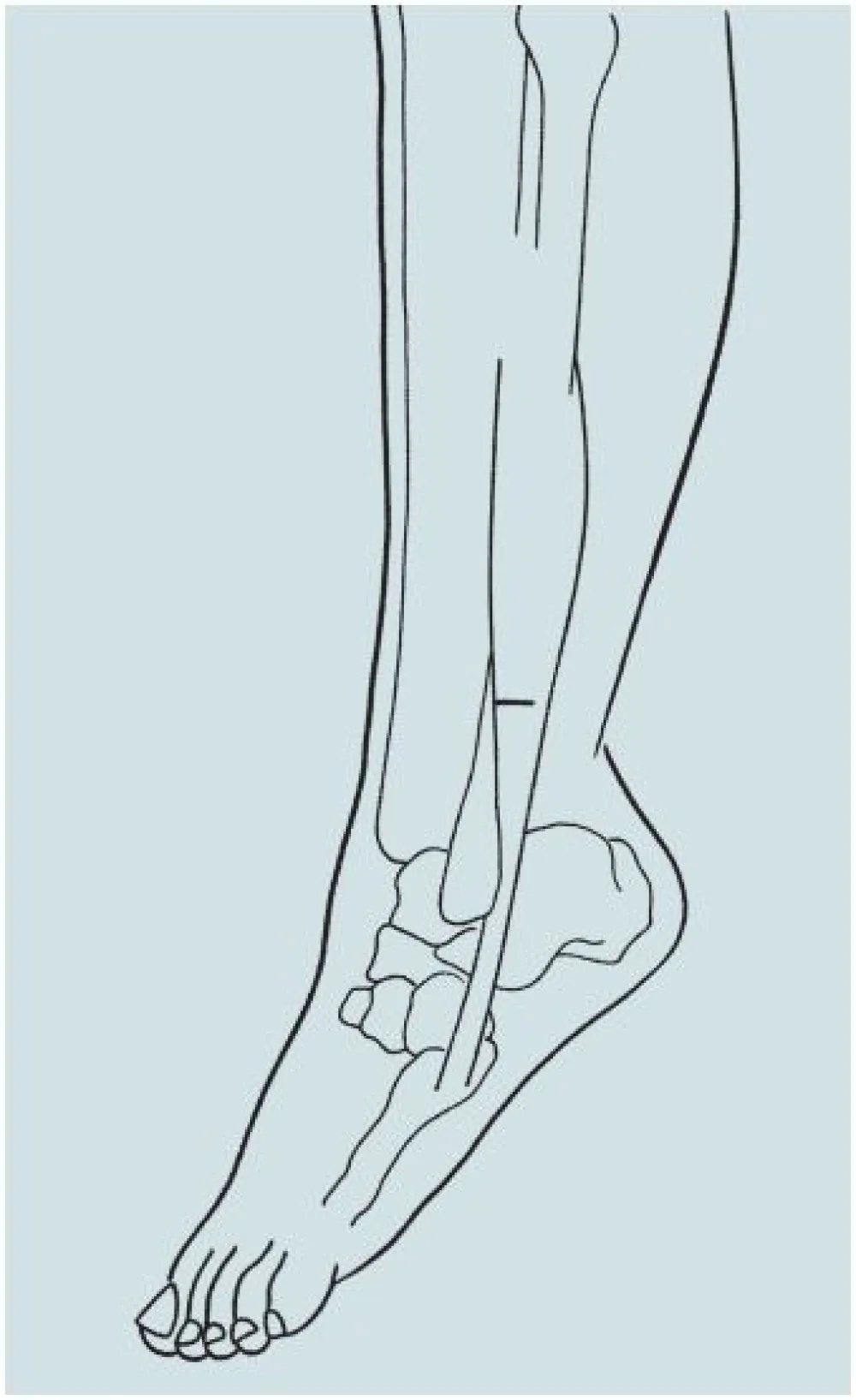 An illustration of the Peroneal Lengthening procedure at Gillette Children's