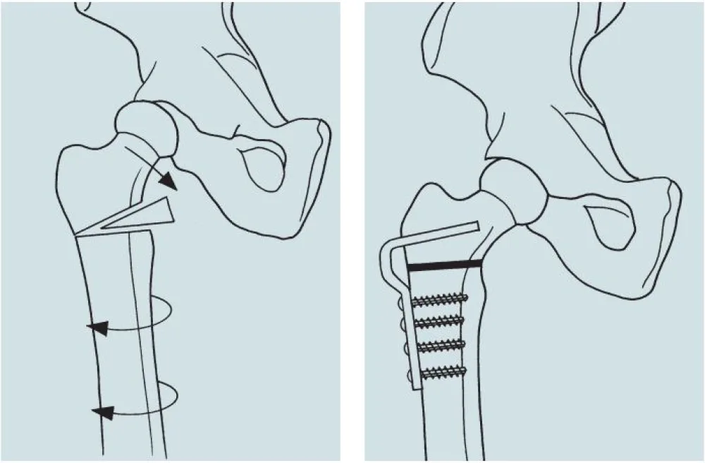 Illustration of Proximal Femoral Osteotomy procedure at Gillette Children's