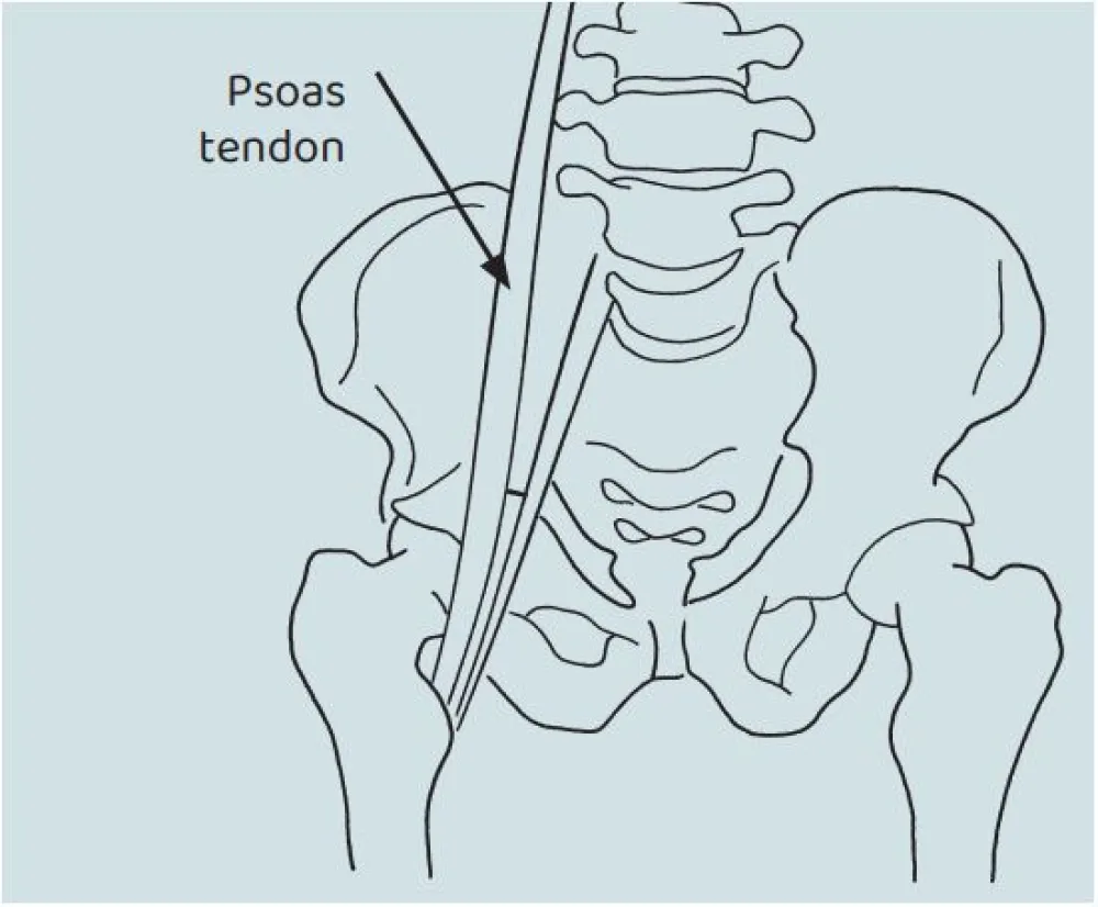 An illustration of the Psoas Lengthening procedure at Gillette Children's