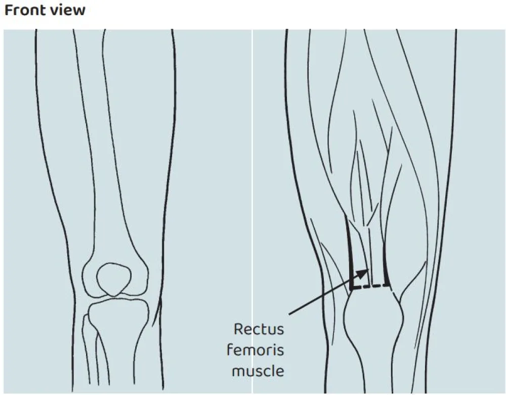 An illustration of the Rectus Femoris Transfer or Recession procedure at Gillette Children's