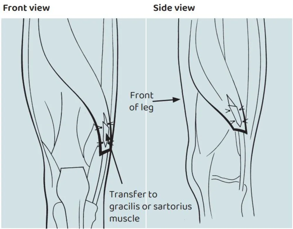 An illustration of the Rectus Femoris Transfer or Recession procedure at Gillette Children's
