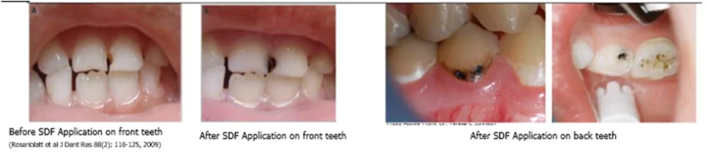 Photos of mouths before and after application of silver diamine fluoride application.