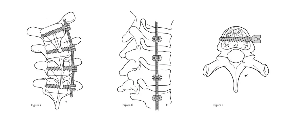 An illustration of Vertebral Body Tethering (VBT)